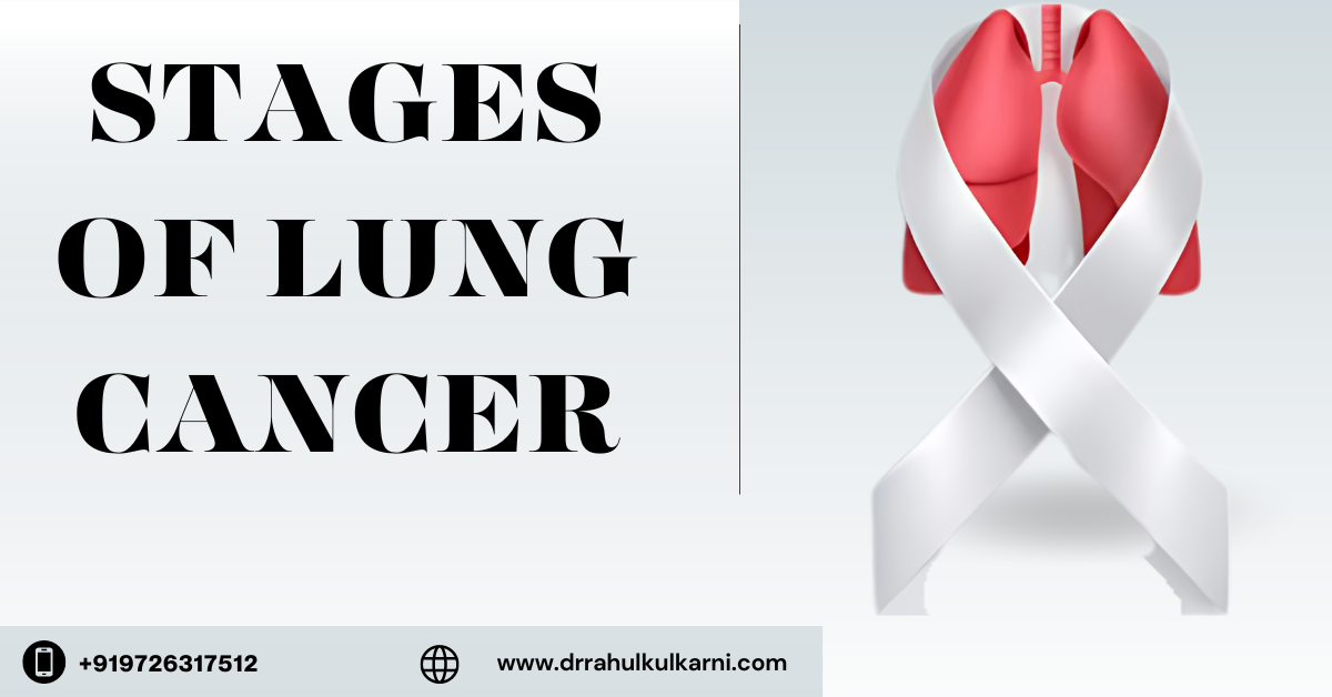 Stages of Lung Cancer